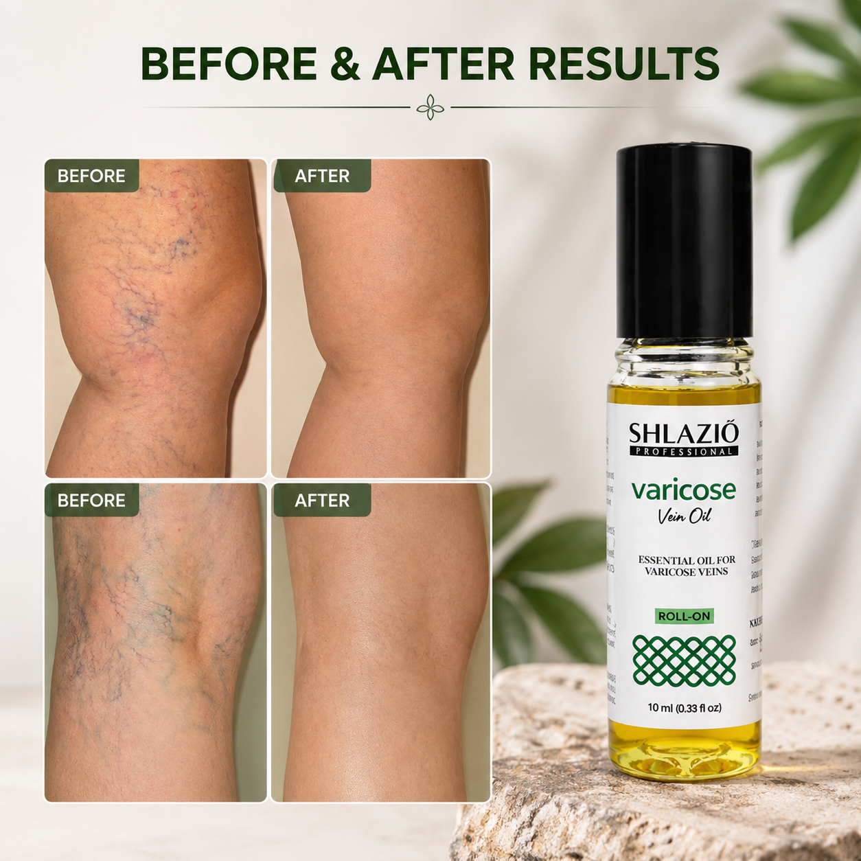 Varicose Veins Relief Oil